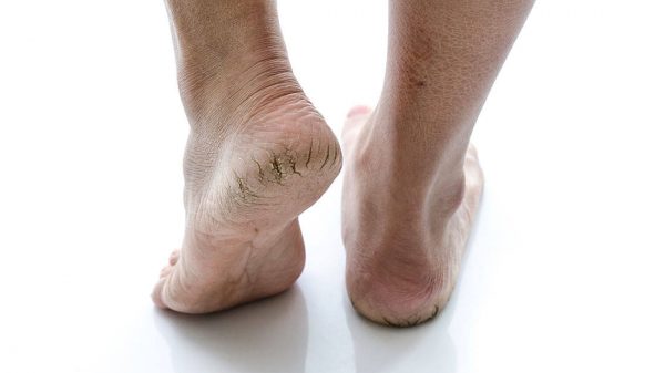 cracked-feet21